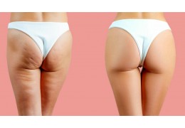 RITENZIONE IDRICA E CELLULITE: condanna a vita o mancanza di volontà?